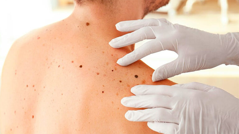 Morón se suma a la campaña federal para la prevención del cáncer “Salvá tu piel” sin título 4